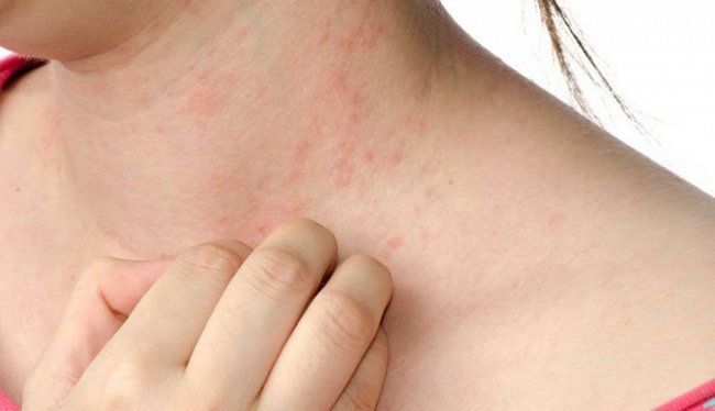 Rubella là một bệnh gây ra do tình trạng nhiễm siêu vi
