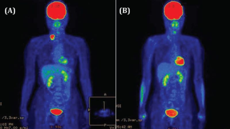 PET-CT