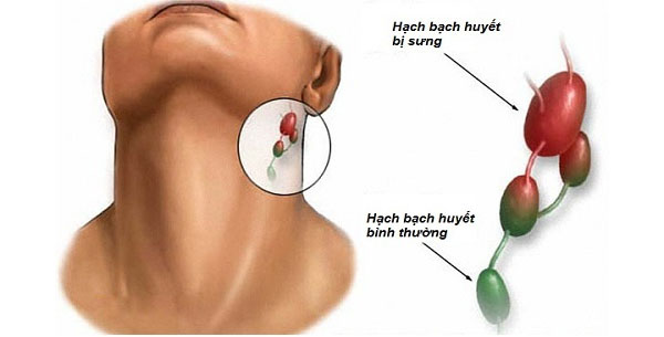 Amidan chứa các hạch bạch huyết, nơi sản xuất các hoạt chất có tác dụng miễn dịch