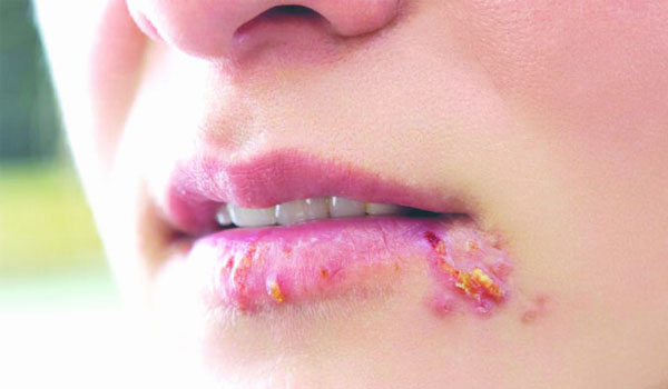 Bệnh Herpes hay còn được biết đến với tình trạng mụn rộp xung quanh miệng và môi