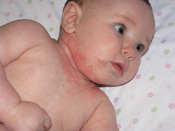 Đa số các trường hợp dị ứng do sữa đậu nành thường xảy ra ở trẻ sơ sinh