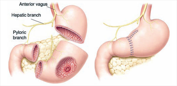 Phẫu thuật là phương pháp điều trị quan trọng trong ung thư, đặc biệt là giai đoạn sớm. Phẫu thuật triệt căn có thể loại bỏ hoàn toàn khối u khi chưa xâm lấn, di căn