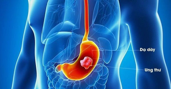 Ung thư dạ dày là căn bệnh rất phổ biến hiện nay, chỉ đứng sau ung thư phổi