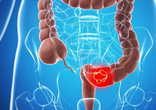 ng thư đại tràng đang là một trong những loại ung thư hàng đầu với tỷ lệ mắc ngày càng tăng