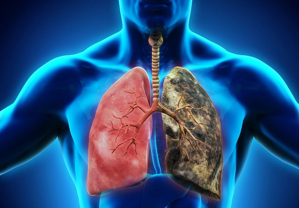 Bệnh nhân ung thư phổi thường được phát hiện ở giai đoạn muộn