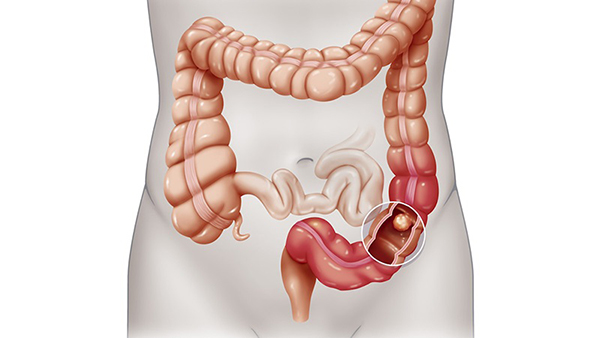 Các chất độc hại tồn đọng gây ung thư trực tràng
