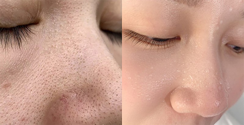 Retinol hỗ trợ điều trị mụn