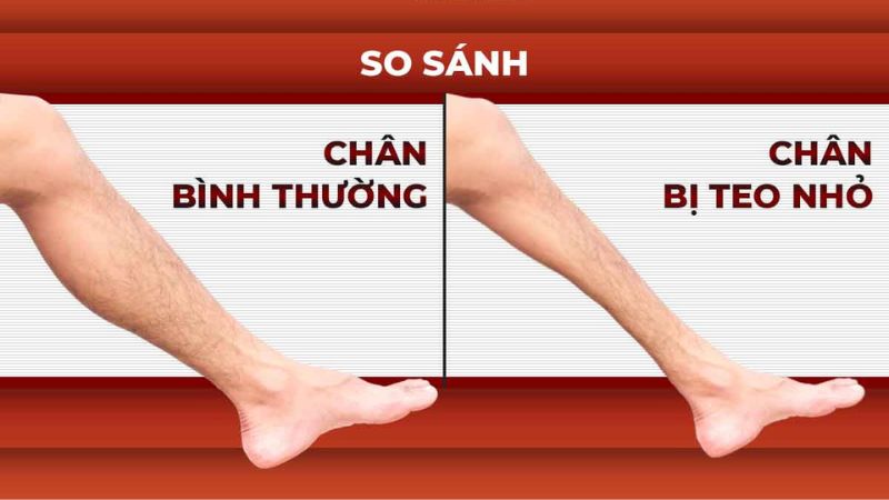 Triệu chứng