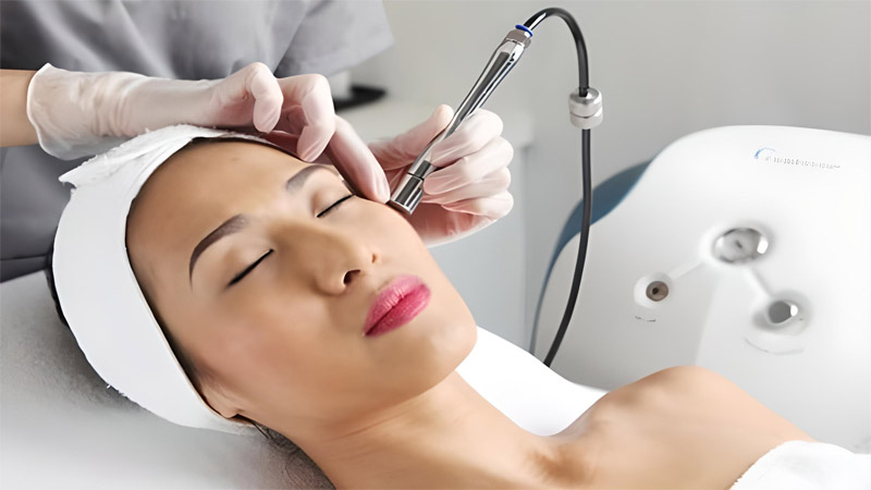 Lăn kim tế bào gốc trị mụn