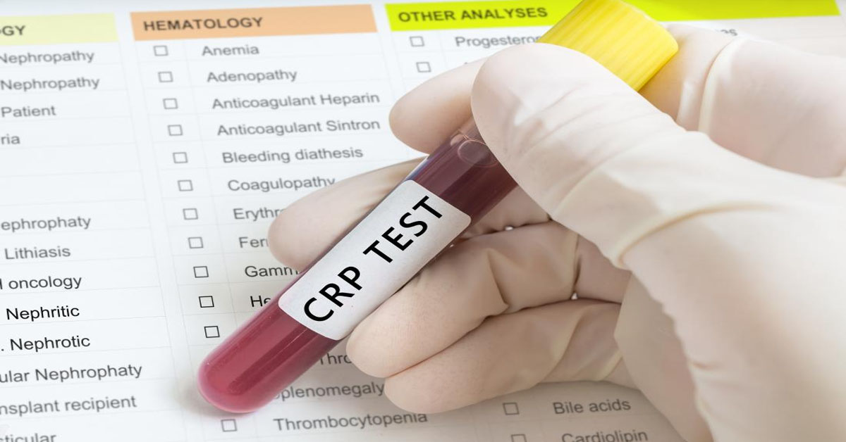 CRP là gì? Chỉ số CRP tăng cao là gì? Ý nghĩa xét nghiệm CRP