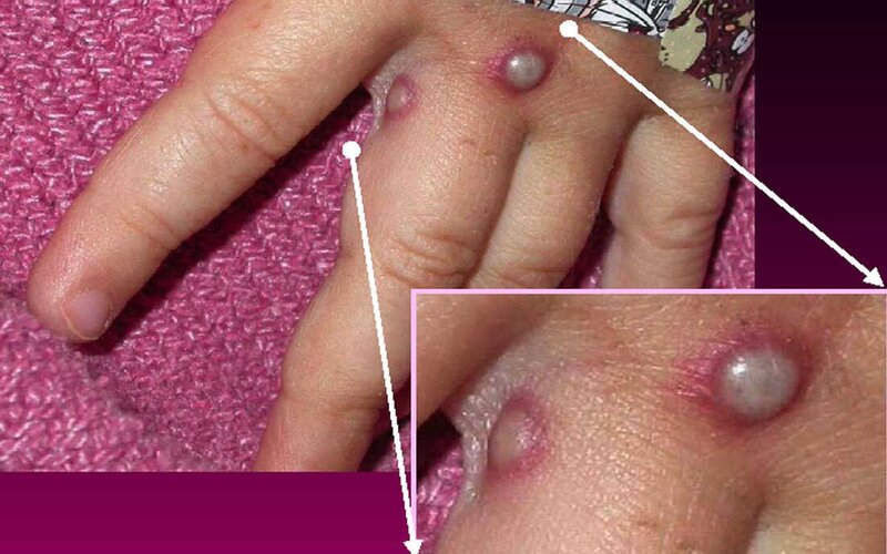 Dấu hiệu khi mắc bệnh đậu mùa khỉ