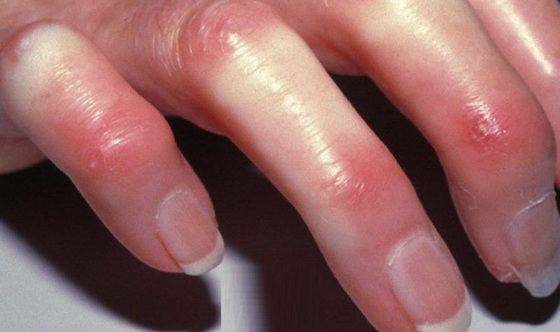 Các bệnh tạo keo
