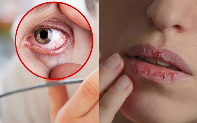 Khô mắt và miệng