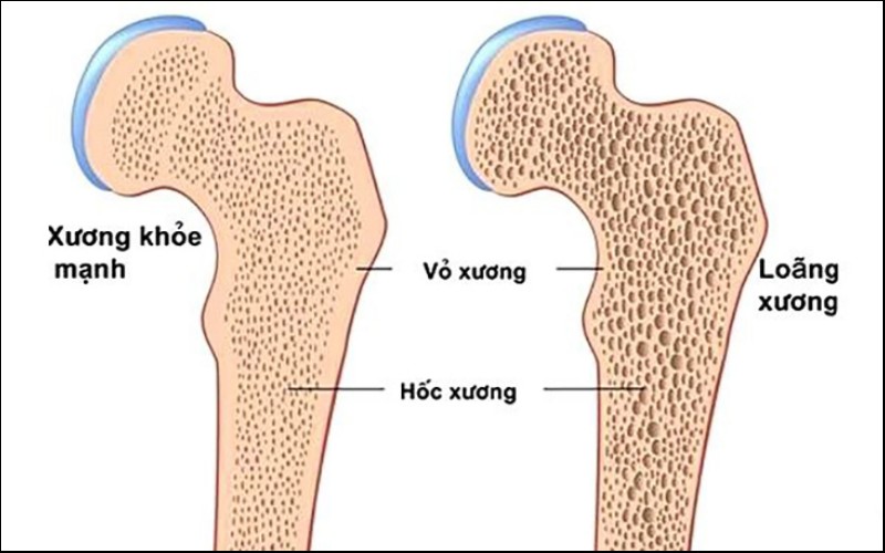 Loãng xương cũng là biến chứng của bệnh viêm khớp dạng thấp