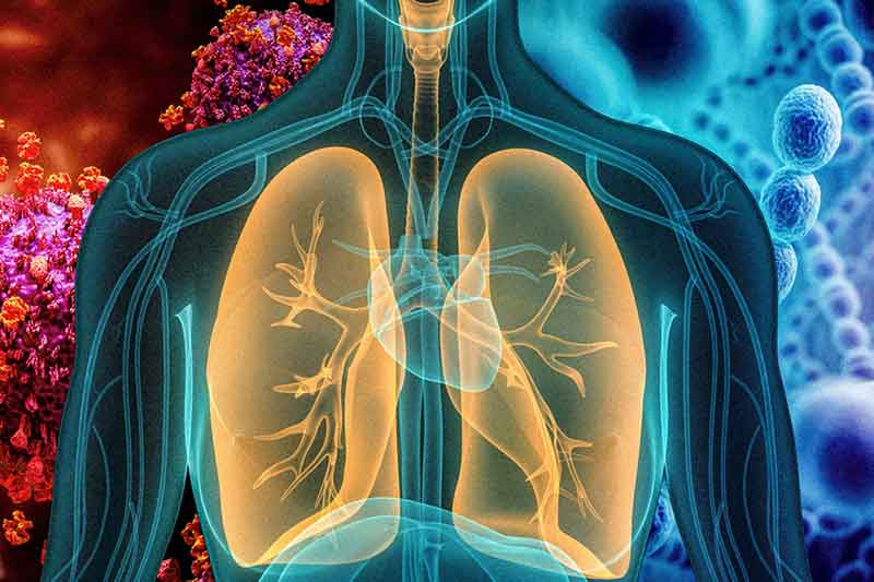 Pneumonia là bệnh gì?