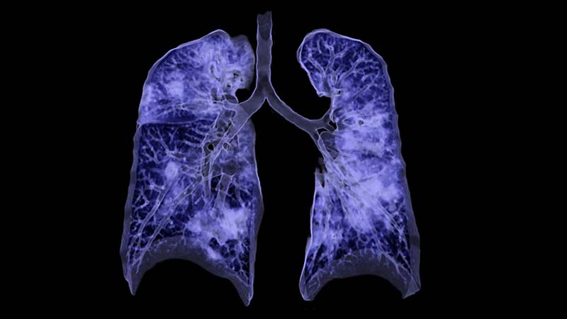 Một số câu hỏi liên quan đến Pneumonia là gì?