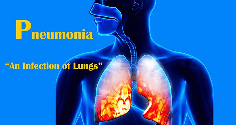 Cách điều trị bệnh pneumonia