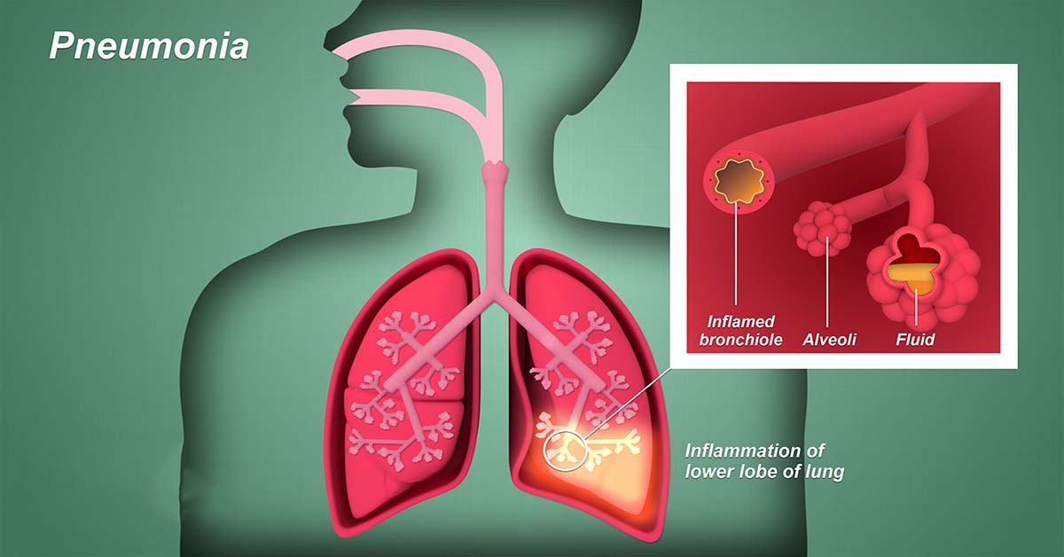 pneumonia là gì