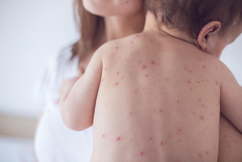 Thủy đậu là bệnh do siêu vi khuẩn Herpes zoster gây ra