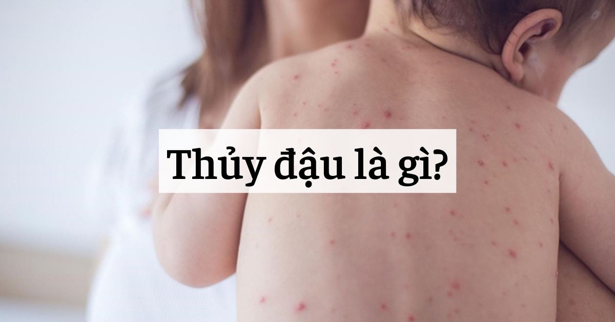 Thủy đậu là gì? Nguyên nhân, Triệu chứng và Cách phòng ngừa