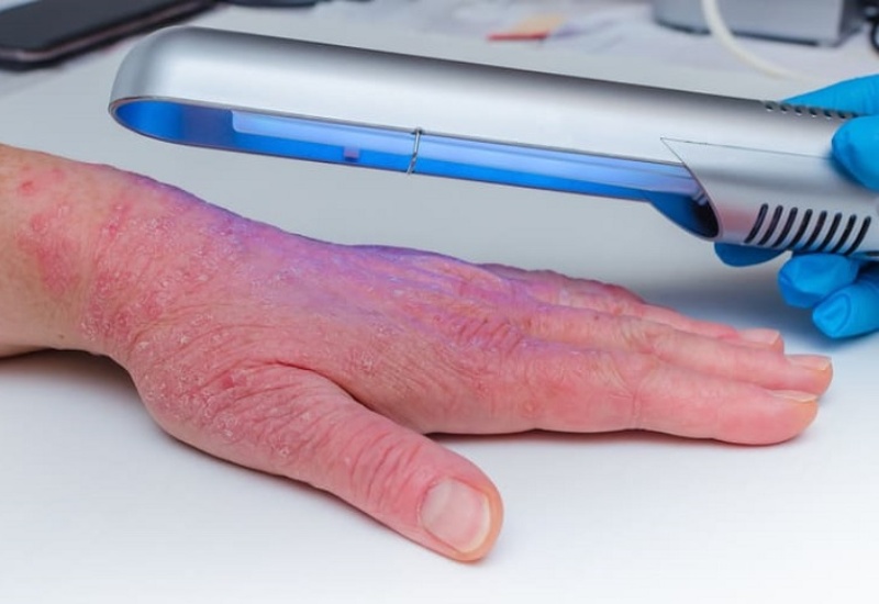 Tia UV giúp điều trị bệnh vảy nến