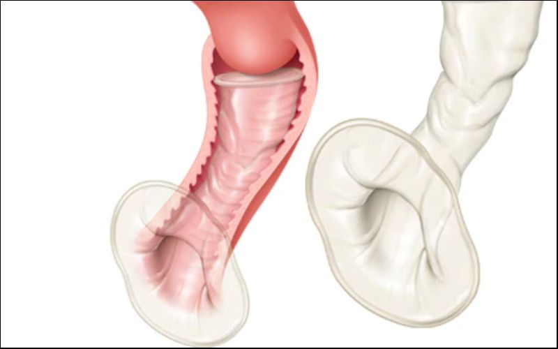 Bao cao su nữ che chắn và bảo vệ bên trong và bên ngoài âm đạo