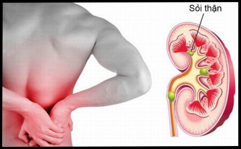 Đối tượng có nguy cơ mắc sỏi thận