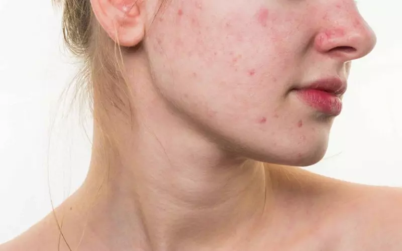 Nếu da xuất hiện các dấu hiệu như đỏ, ngứa, sưng hoặc kích ứng khi sử dụng sản phẩm, thì bạn nên dừng sử dụng sản phẩm