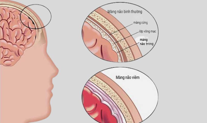 Phát hiện sớm viêm màng não mủ cấp