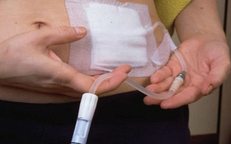 Thẩm phân phúc mạc