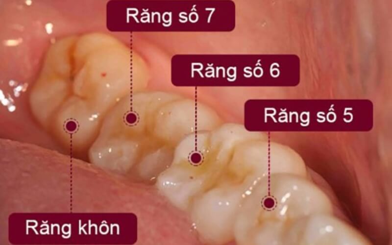 Trường hợp không nên nhổ răng khôn