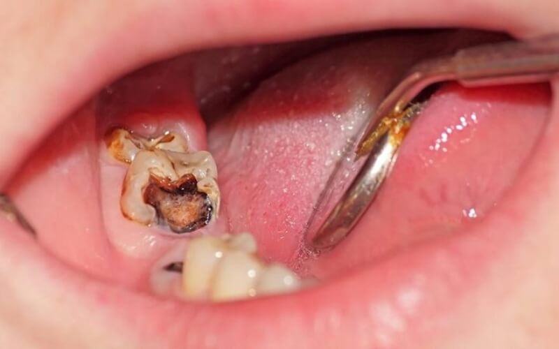 Trường hợp nên nhổ răng khôn