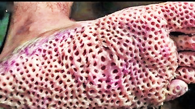 Trypophobia là gì?