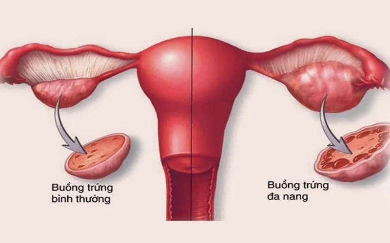 Buồng trứng đa nang (phải) so với buồng trứng bình thường