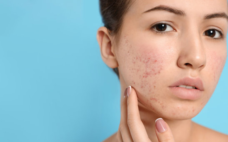 Các biến chứng có thể gặp khi bị mụn