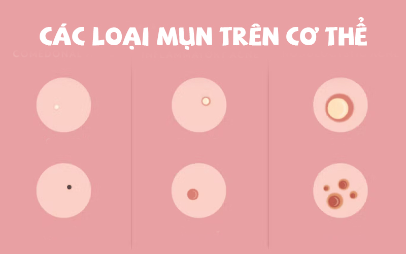 Các loại mụn trên cơ thể