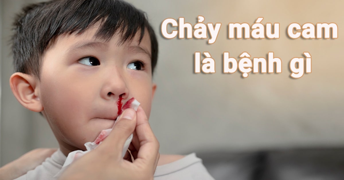 chảy máu cam là bệnh gì