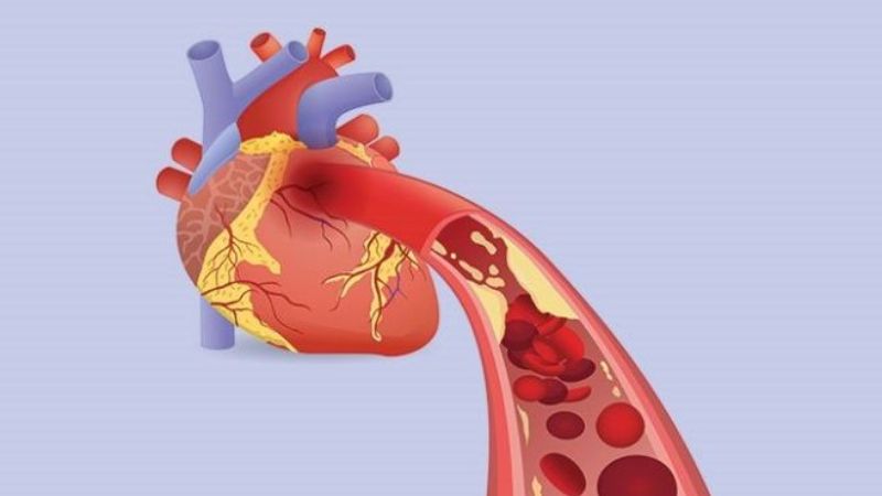 Nguyên nhân chính dẫn đến nhồi máu cơ tim là xơ vữa động mạch Nguyên nhân chính dẫn đến nhồi máu cơ tim là xơ vữa động mạch