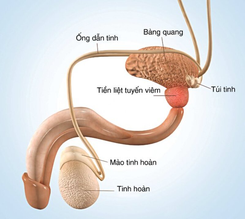 Tiền liệt tuyến bị viêm nhiễm nặng