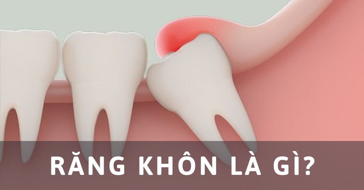 răng khôn là gì