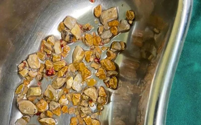 Lượng lớn sỏi được lấy ra từ 1 ca phẫu thuật