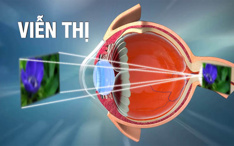 Nguyên nhân gây ra bệnh viễn thị chủ yếu là do trục nhãn cầu ngắn so với bình thường