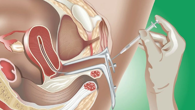 Bác sĩ sẽ bơm tinh trùng từ ống vào tử cung