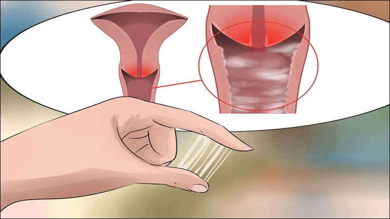 Nguyên nhân do chất nhầy ở cổ tử cung quá dày làm tinh trùng khó có thể thụ tinh