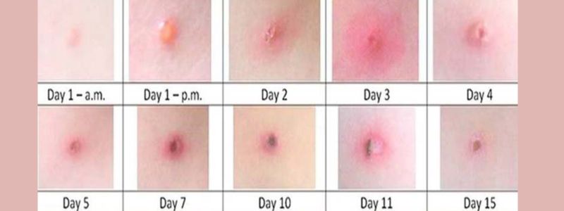 Giai đoạn phát triển của bệnh thủy đậu