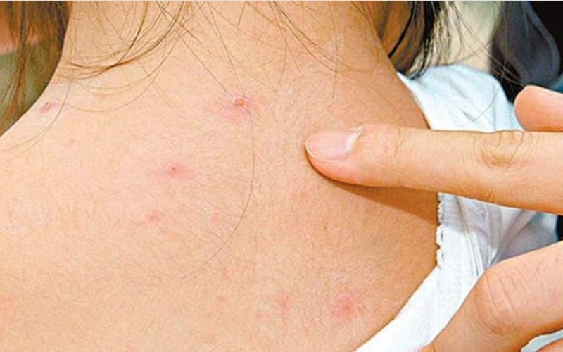 Dấu hiệu hết bệnh thủy đậu