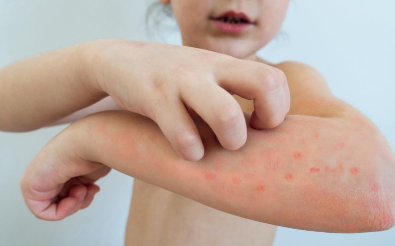Không dùng tay gãi, gây vỡ vụn nước để tránh bị nhiễm khuẩn