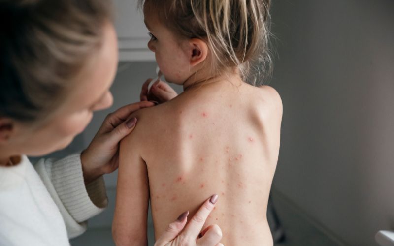 Một số câu hỏi thường gặp về bệnh thủy đậu