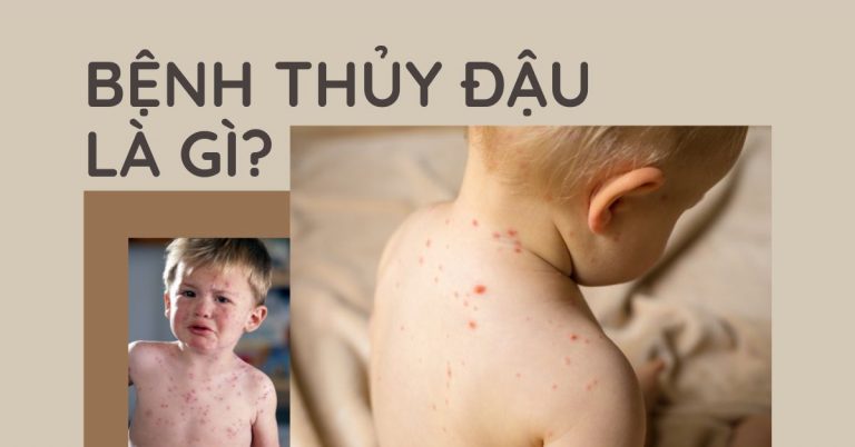 Thủy đậu là gì? Nguyên nhân, Triệu chứng và Cách phòng ngừa