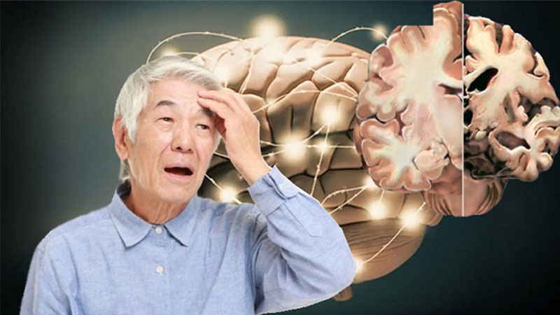 Nguyên nhân của bệnh Alzheimer vẫn chưa được biết rõ